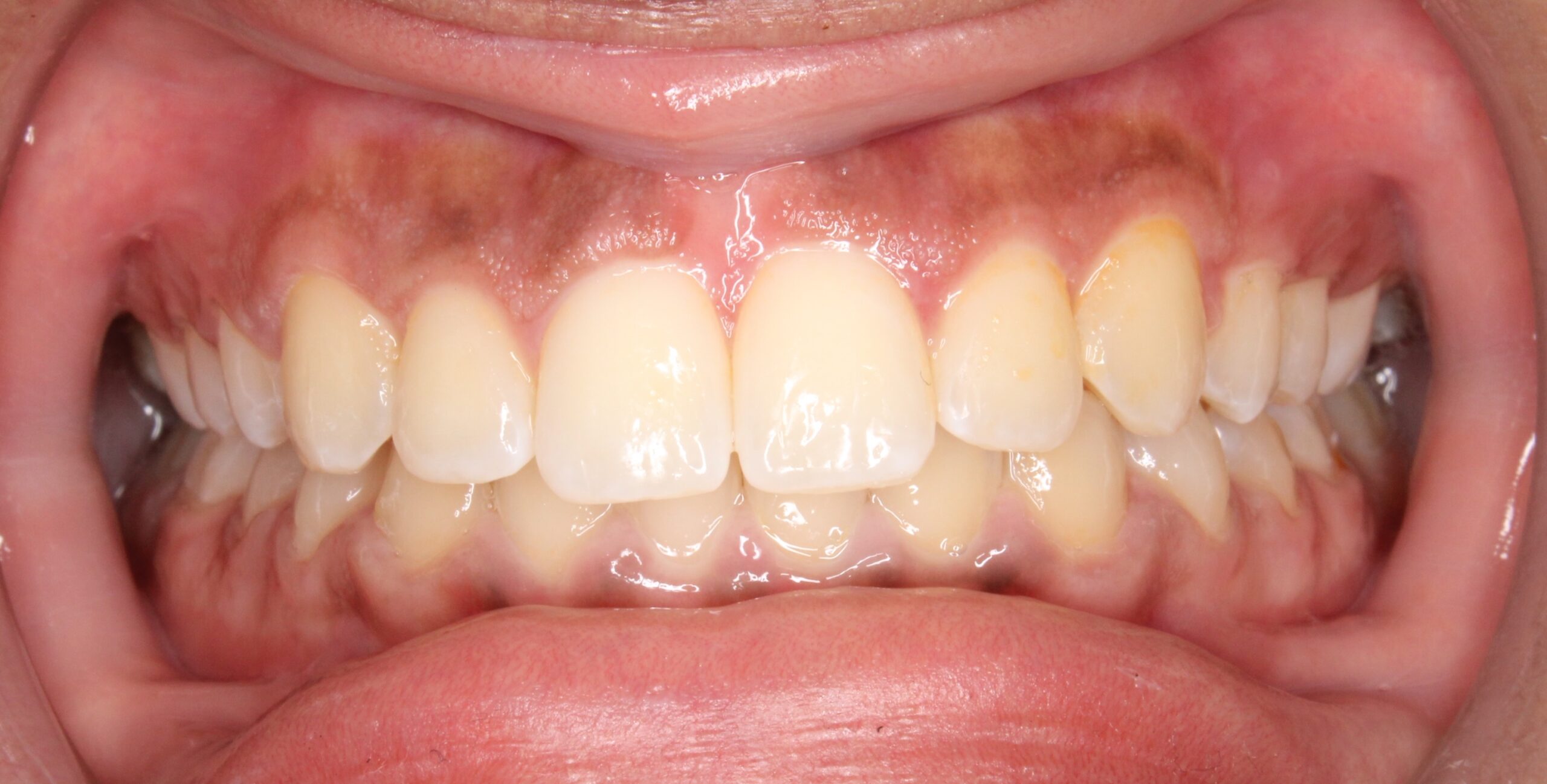 A patient after gingival lasering to show more tooth structure and lessen the gummy smile treated by Dr. Mana Naeim at Serene Orthodontics.