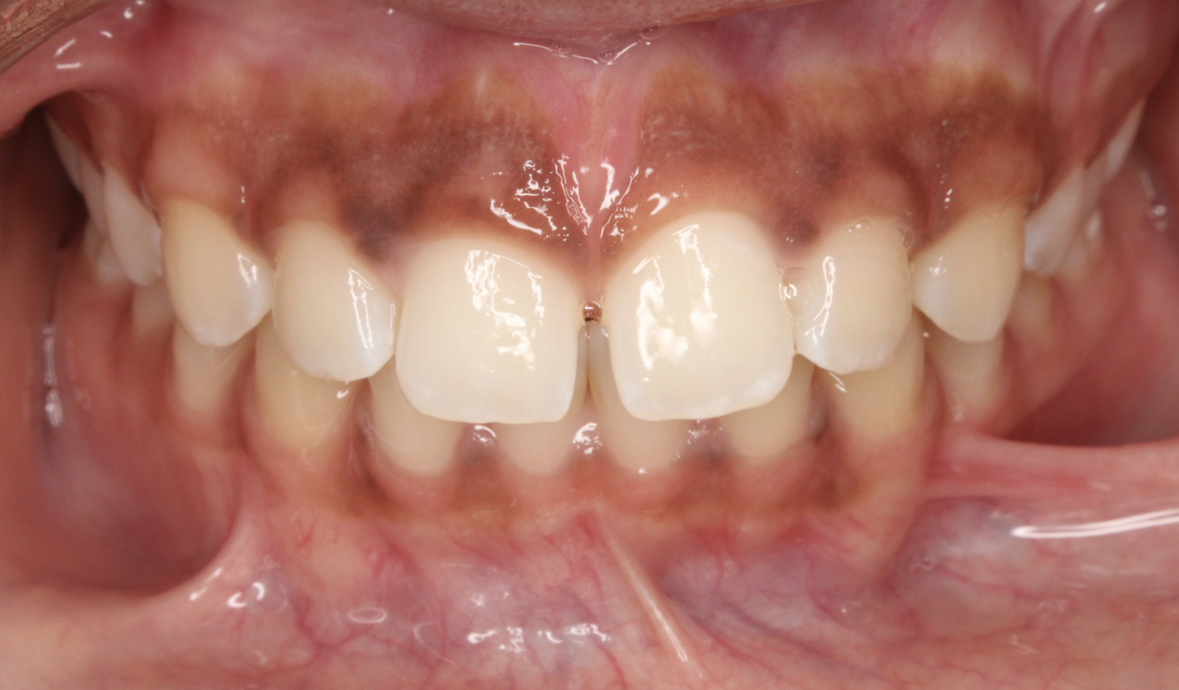 A patient with excessive gingival display (gummy smile) prior to treatment at Serene Orthodontics. 