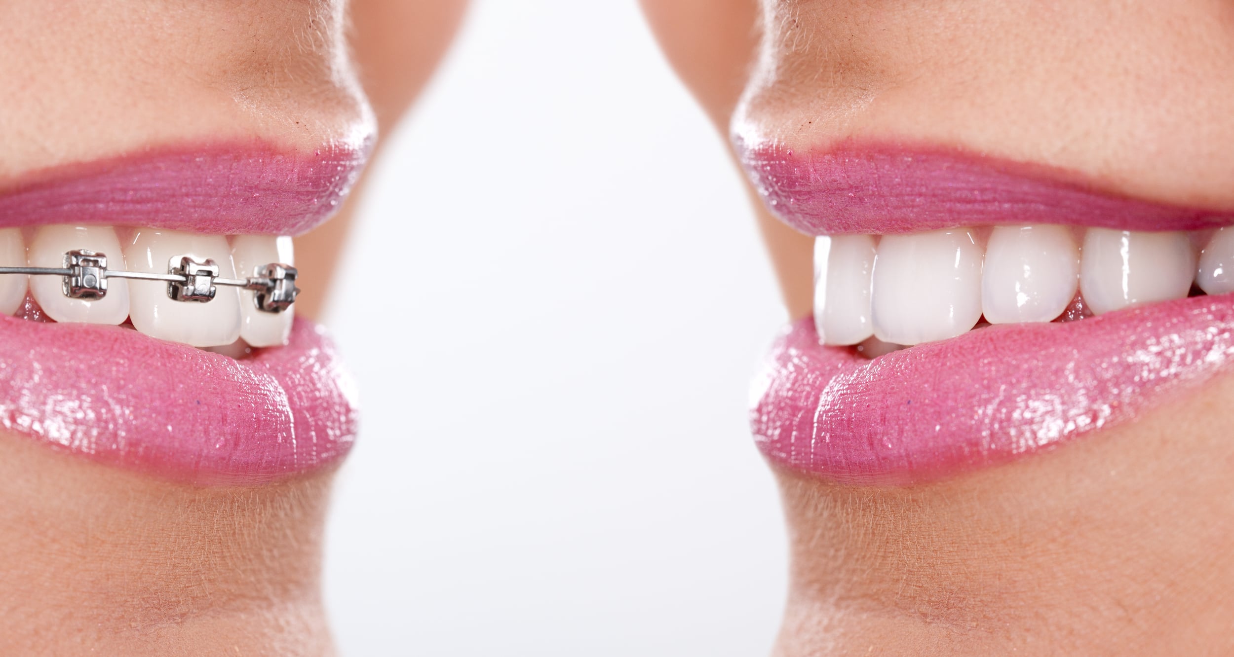 Photo of invisalign branded orthodontics and their results.