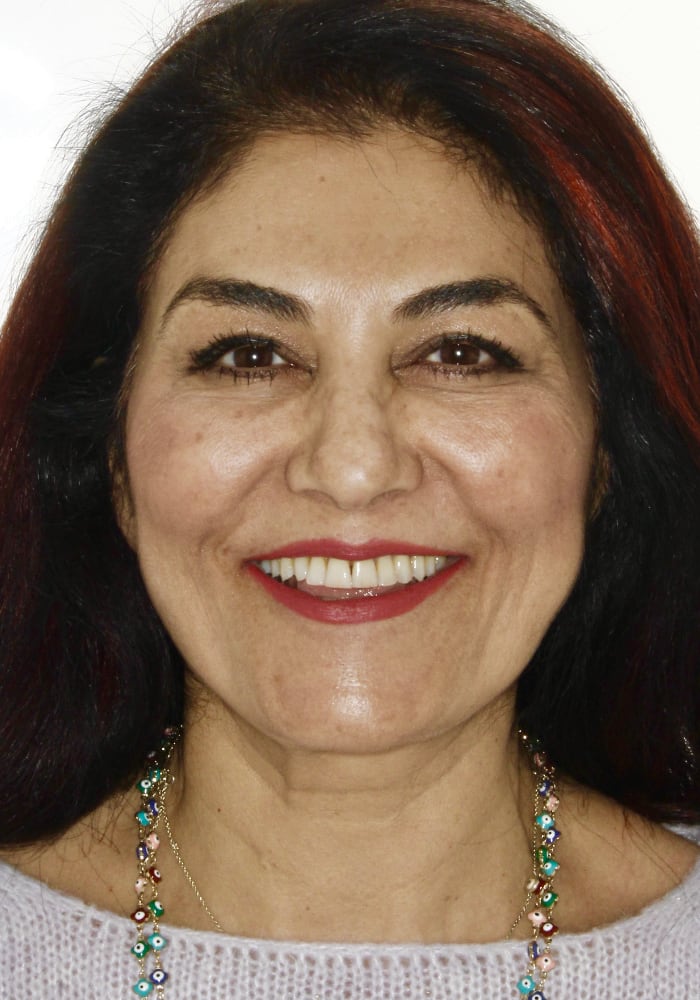 A full face photo of a woman with yellow teeth and black triangles between her center teeth at Serene Orthodontics (Mission Viejo CA)
