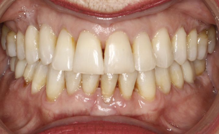 A patient with yellow, crowded teeth and black triangles prior to Invisalign treatment with Dr. Mana Naeim at Serene Orthodontics (Mission Viejo, CA)
