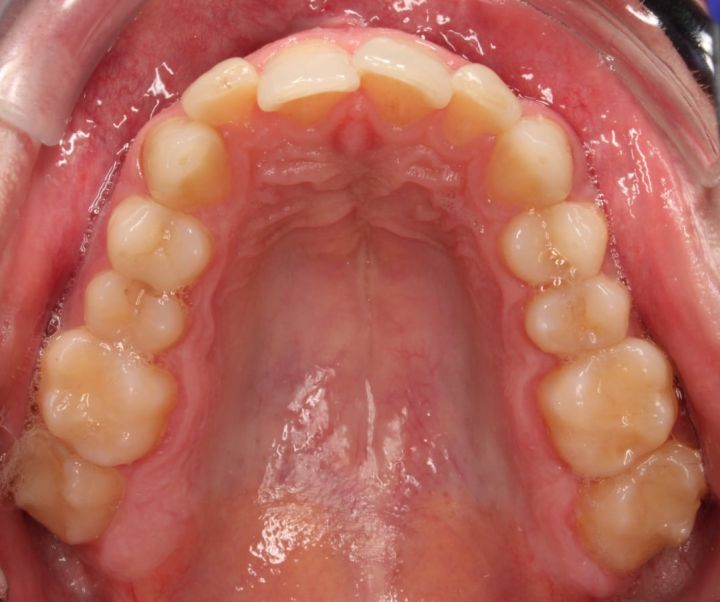 A crowded upper arch prior to Orthodontic Treatment (Mission Viejo, CA) 