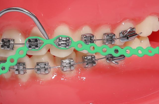 A Green Power Chain going on metal braces