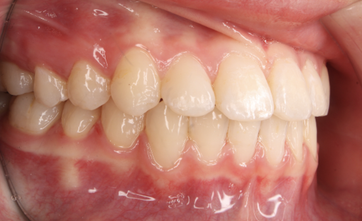 A right side view of a patient whose underbite has been fixed using braces and elastics at Serene Orthodontics by Dr. Mana Naeim (Mission Viejo) 