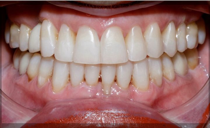 A patient with white, straight teeth, and minimal black triangles after Invisalign treatment and whitening with Dr. Mana Naeim at Serene Orthodontics (Mission Viejo, CA)