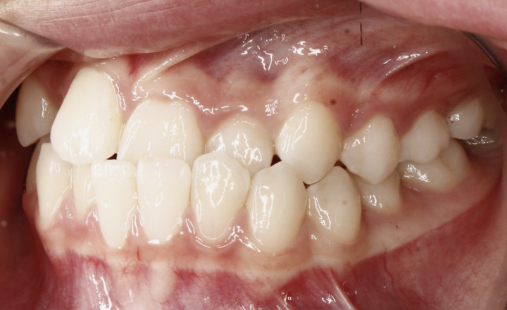 A left side view of a patient with a severe underbite at Serene Orthodontics with Dr. Mana Naeim (Mission Viejo) 